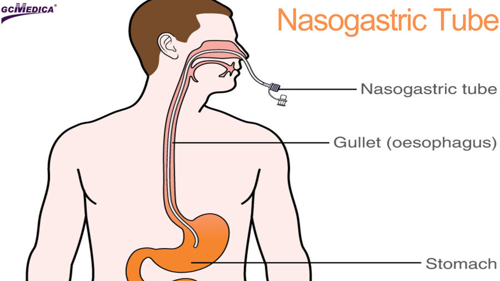 Nasogastric_Tube.jpg